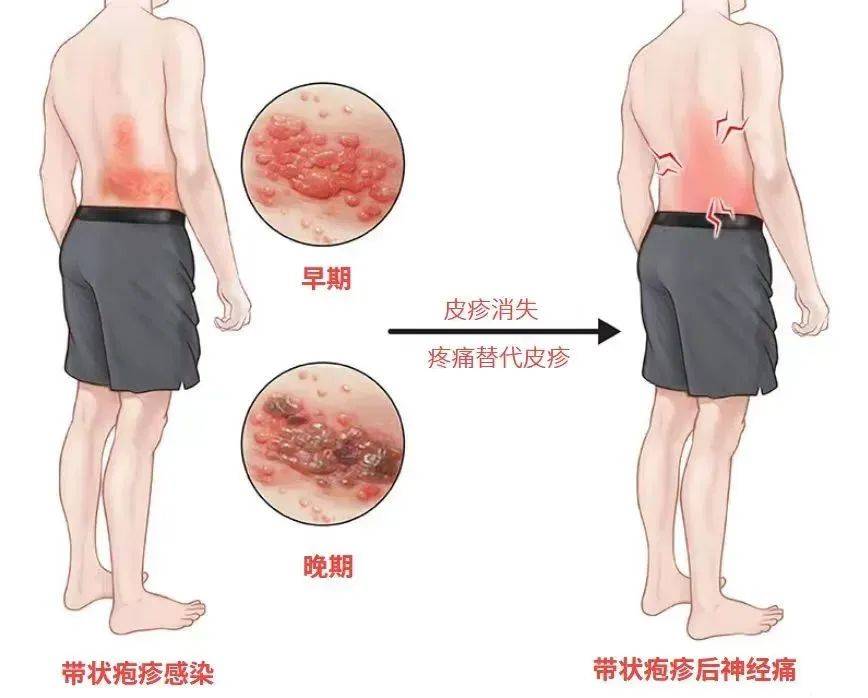 一旦感染终身携带<strong></p>
<p>亿发虚拟币</strong>！深圳疾控提醒：这4类人要注意