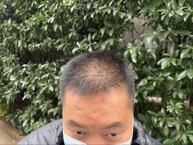“还能反光<strong></p>
<p>虚拟焦耳币</strong>！”长沙男子植发近9月称后脑勺“像狗啃过”