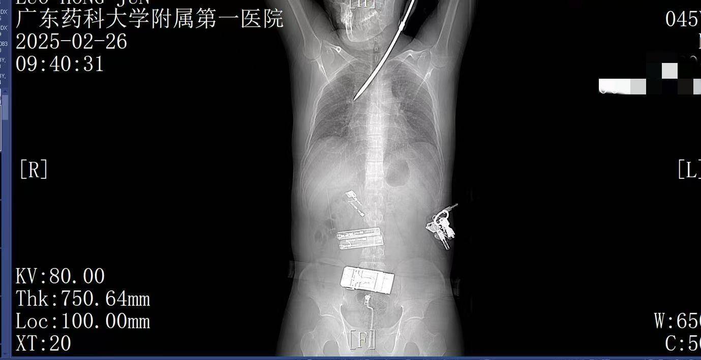 20米高空掉落螺丝刀直插男子胸腔<strong></p>
<p>实盘虚拟币</strong>！医生：不要自行拔除