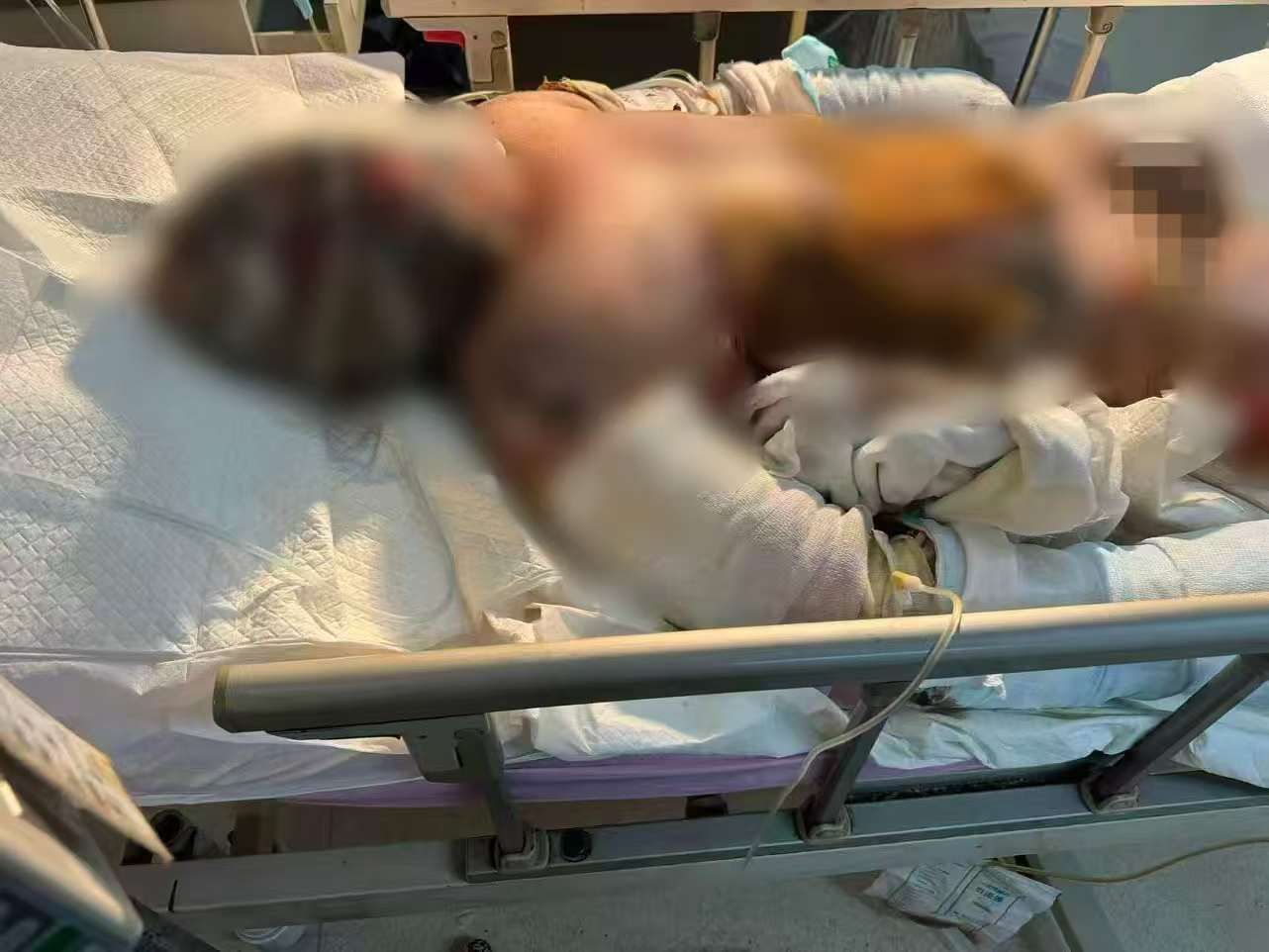 父子在哈尔滨一亲戚公司上班遇爆炸全身烧伤<strong></p>
<p>数字货币套利</strong>，治疗花费近百万公司拒赔偿？亲戚回应