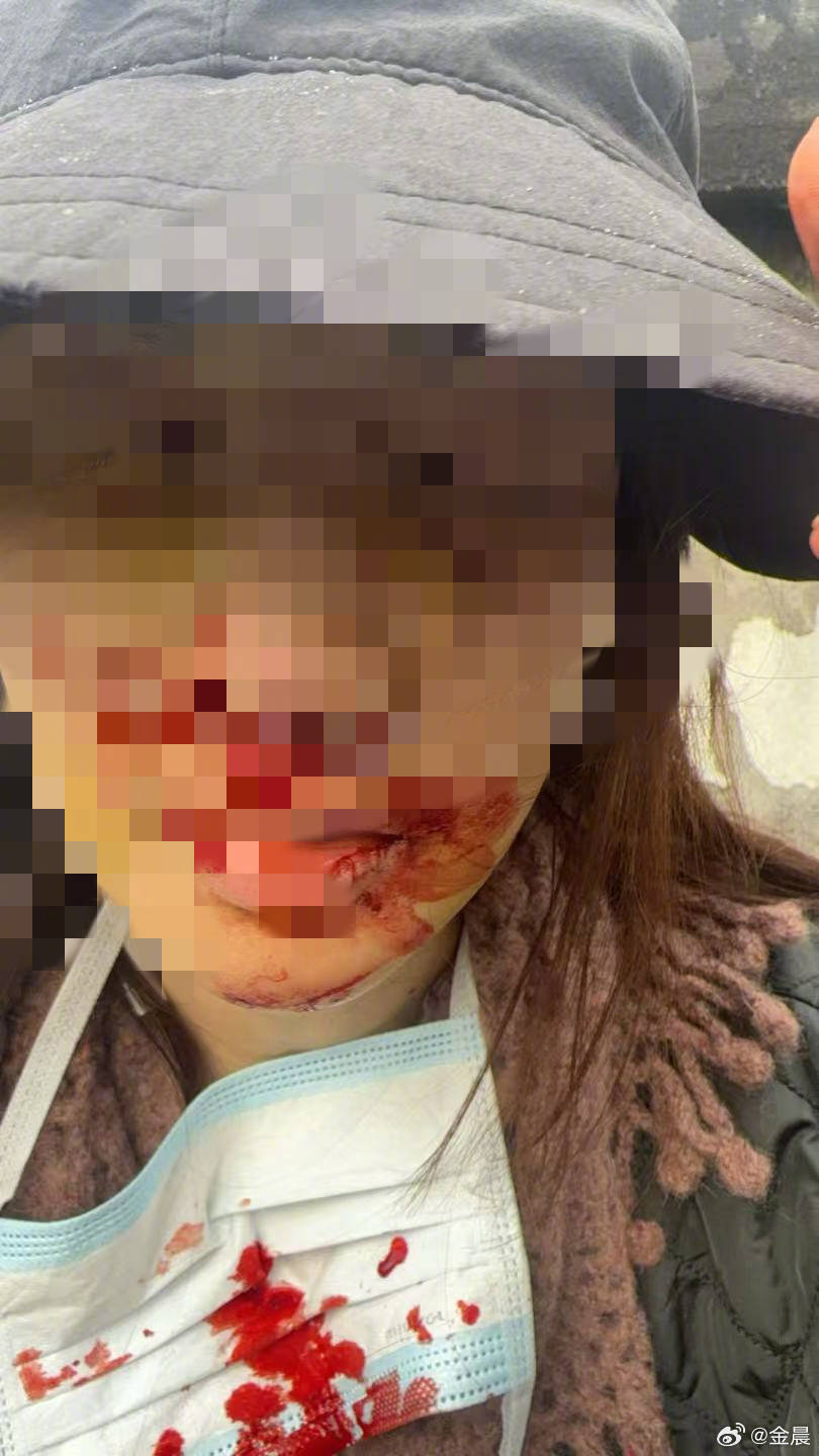 警方发布警情通报后<strong></p>
<p>新数字货币</strong>，金晨晒脸部受伤照片并发文道歉